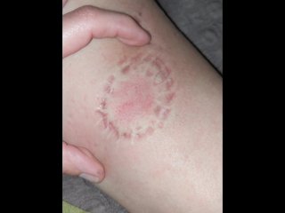 Biting Part 1