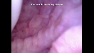 Can I fit the minicam AND a catheter inside my pee hole at the same time?
